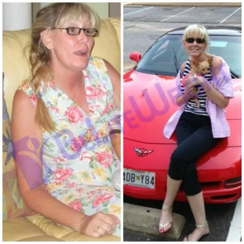 Gastric Sleeve VSG Before and After Photos Bariatric Surgery