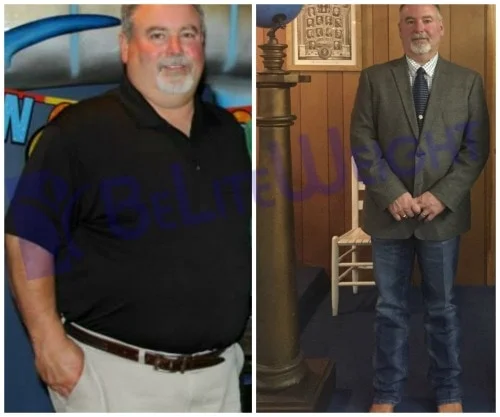 before and after vsg vertical gastric sleeve bypass lap band bariatric