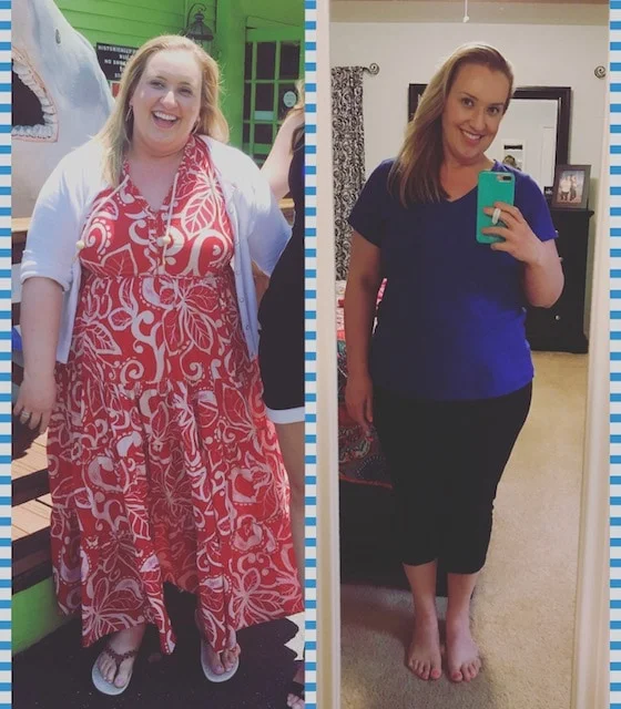 weight loss surgery before and after vsg vertical gastric band bypass