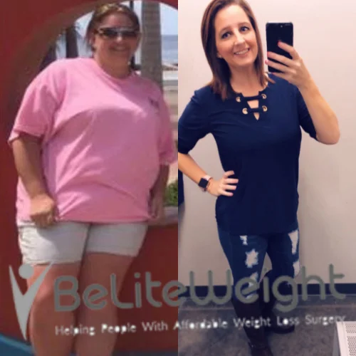Gastric Sleeve before and after Patient - I lost a total of 100 pounds and have been able to keep a good...