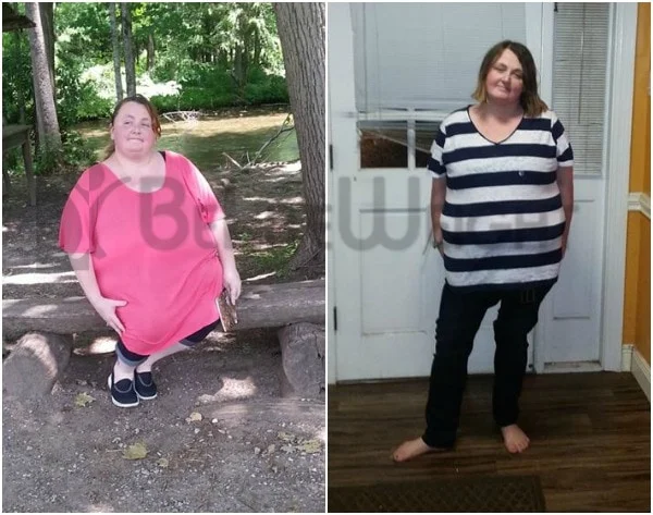 Weight Loss Surgery before and after Woman - I was type 2 Diabetic and I was taking 5 shots and 2 pills a...