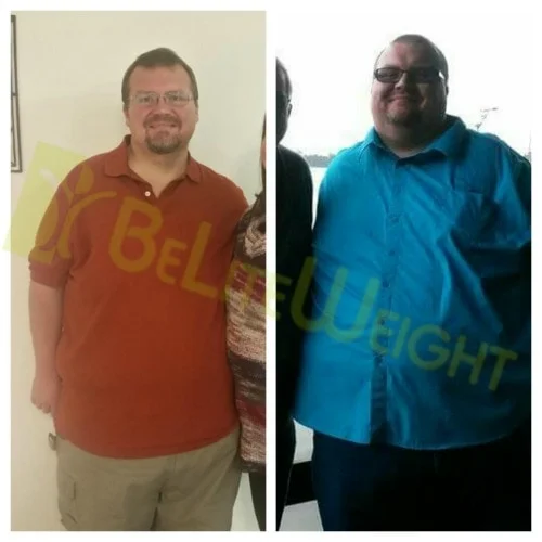 weight loss surgery vsg gastric sleeve before after photos testimonial