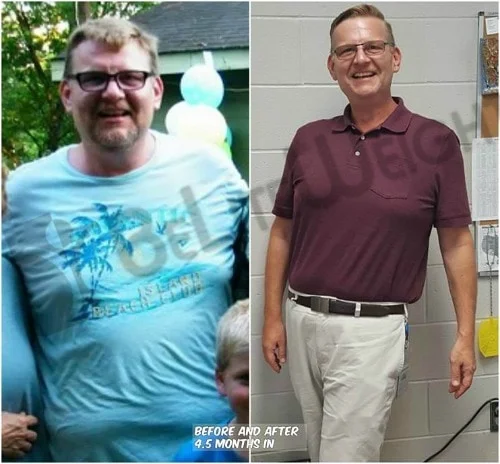 weight loss surgery bariatric before and after vsg band bypass
