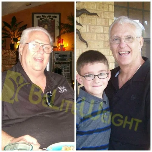 weight loss surgery vsg gastric sleeve before after photos testimonial mini gastric bypass