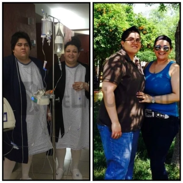 gastric sleeve