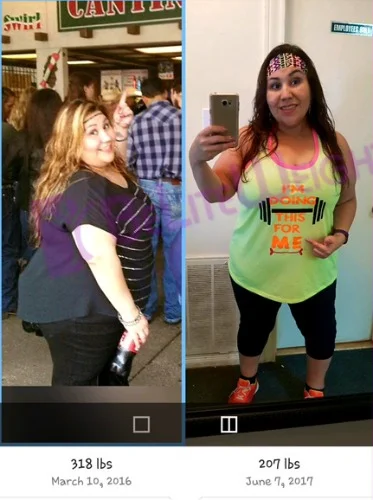 weight loss surgery before and after vsg vertical gastric bypass lap band sleeve