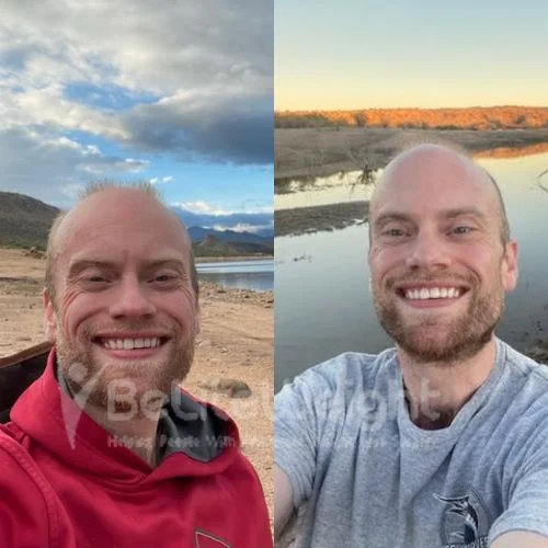 Solomon T - RNY gastric bypass Update after 2 years*