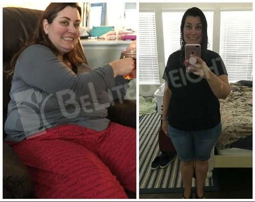 Weight Loss Surgery before and after Patient - Starting weight at time of surgery was 288 and current weight is 214. Surgeons Dr. Jose...