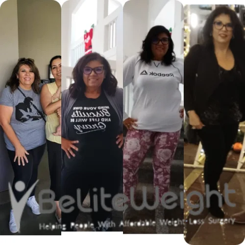 Weight Loss Surgery Gastric Sleeve before and after