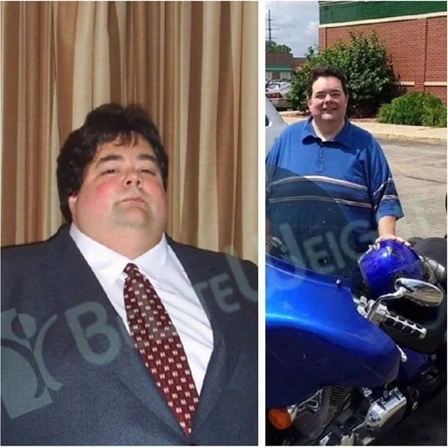 Weight Loss Surgery before and after Patient - Starting weight 375 Current Weight 269 Surgeons Dr. Jose Rodriguez and Elmo AramburoSurgery Gastric Bypass *See Below