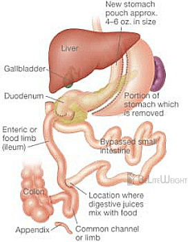 Duodenal Switch – DS Duodenal Switch – DS