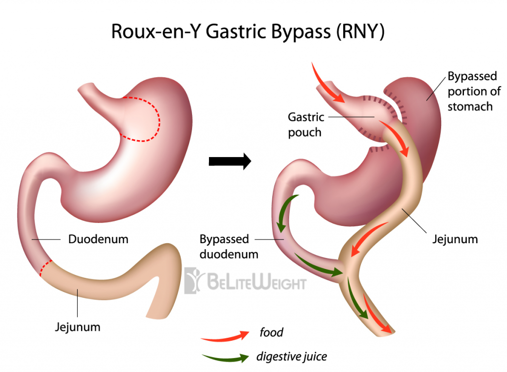 Gastric Bypass - Roux-en-Y Bypass