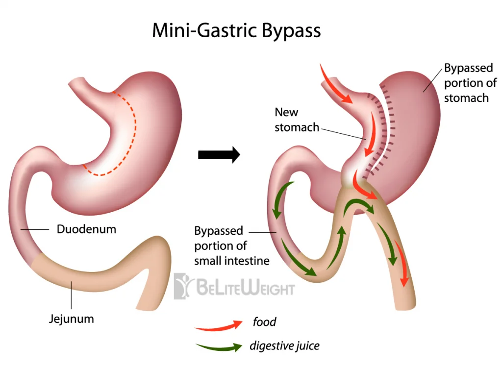 Mini Gastric Bypass