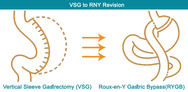 Revision Weight Loss Surgery