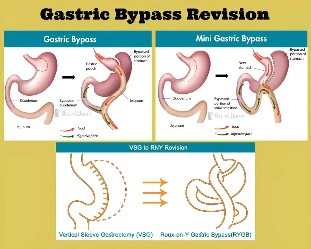 Gastric Bypass Revision