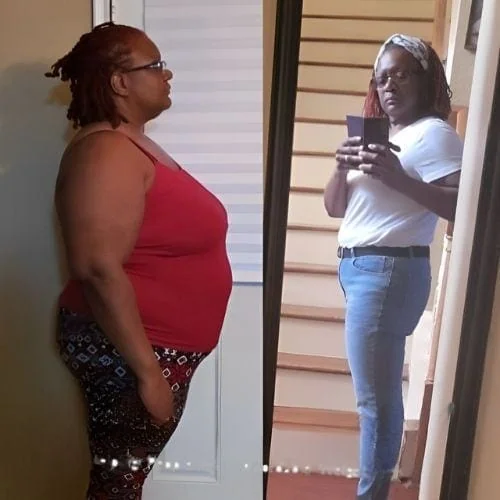 Gastric Bypass Revision Before and After Surgery