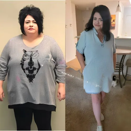 Gastric Bypass Revision Before and After Surgery Photos