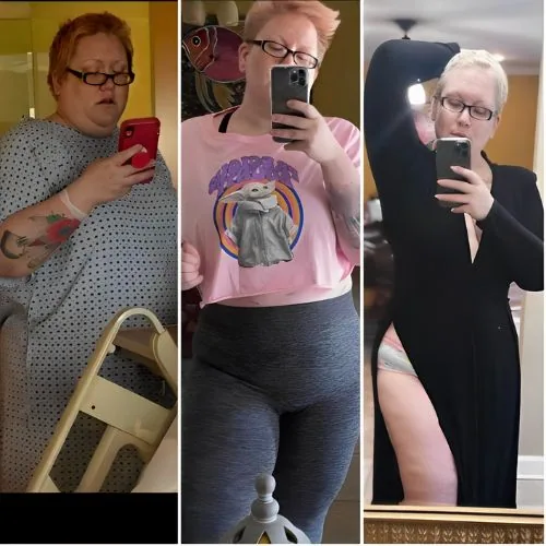 Gastric Bypass Revision Before and After