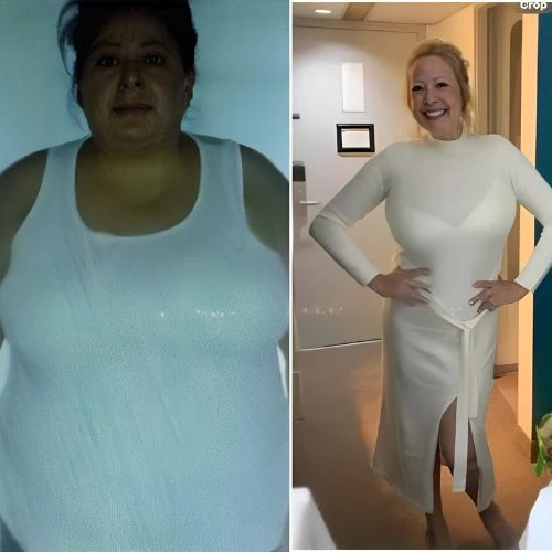 Gastric Bypass Revision Patient Testimonials Images