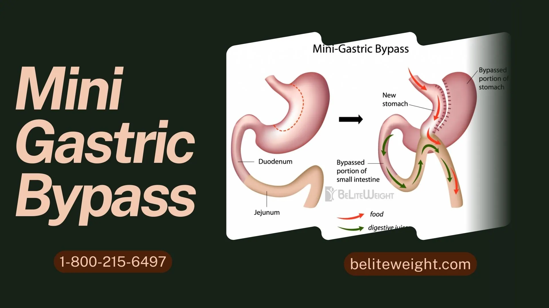 Mini Gastric Bypass